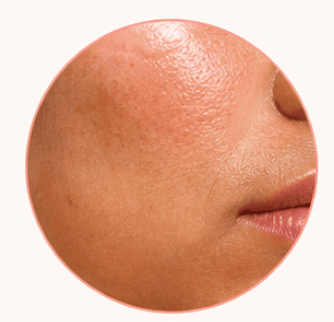 Dull Skin